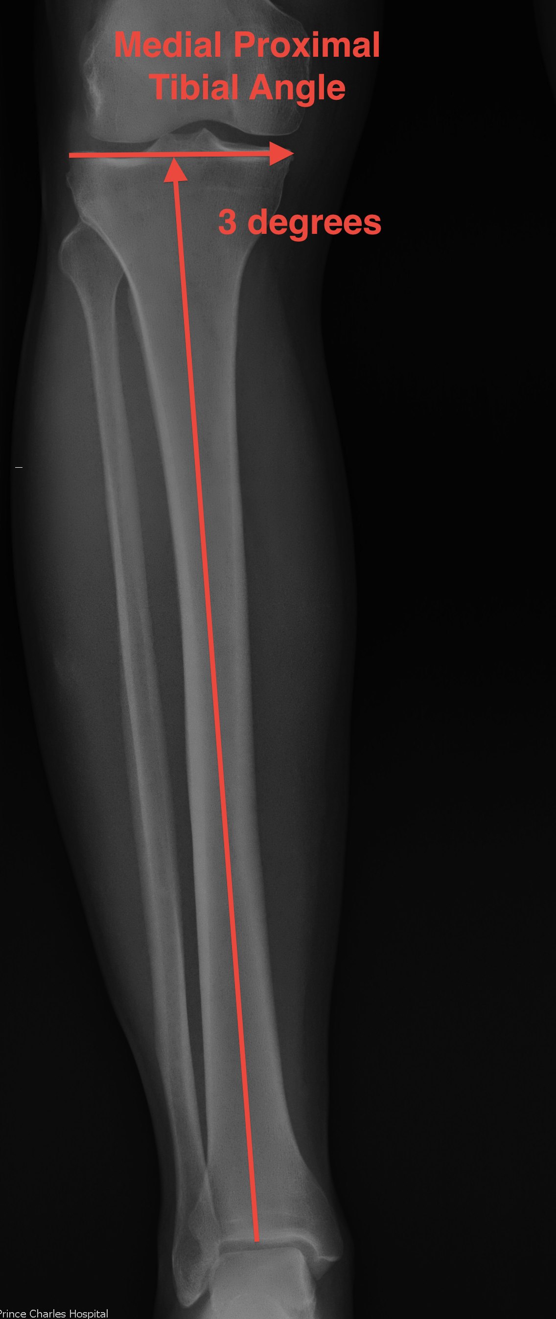 Medial Proximal Tibial Angle